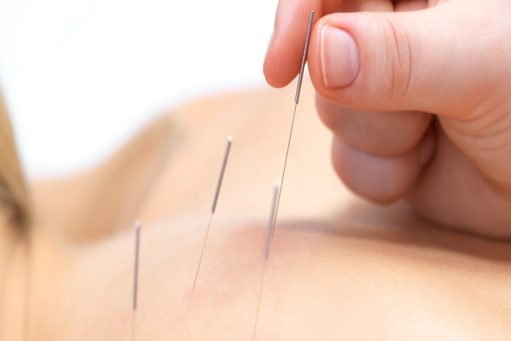 What is the difference between dry needling and acupuncture?