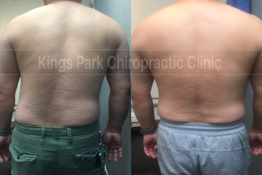 Patient Story – Disc Herniation