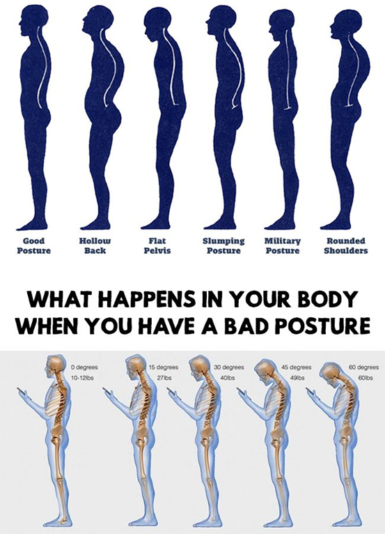 The Effects of Bad Posture - Merckling Family Chiropractic
