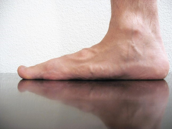Could Chiropractic Care Treat Flat Foot?