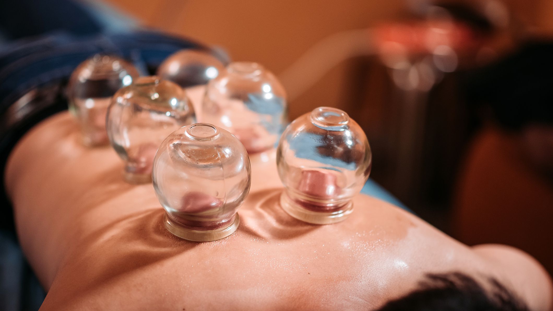 Why Cupping is Good for Weight Loss