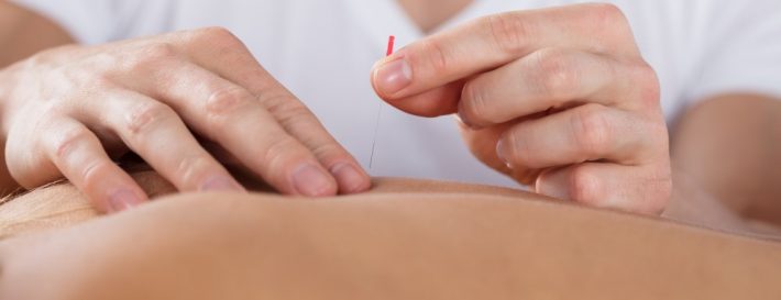 Dry Needling For Tendonitis Pain Relief – Does It Work?