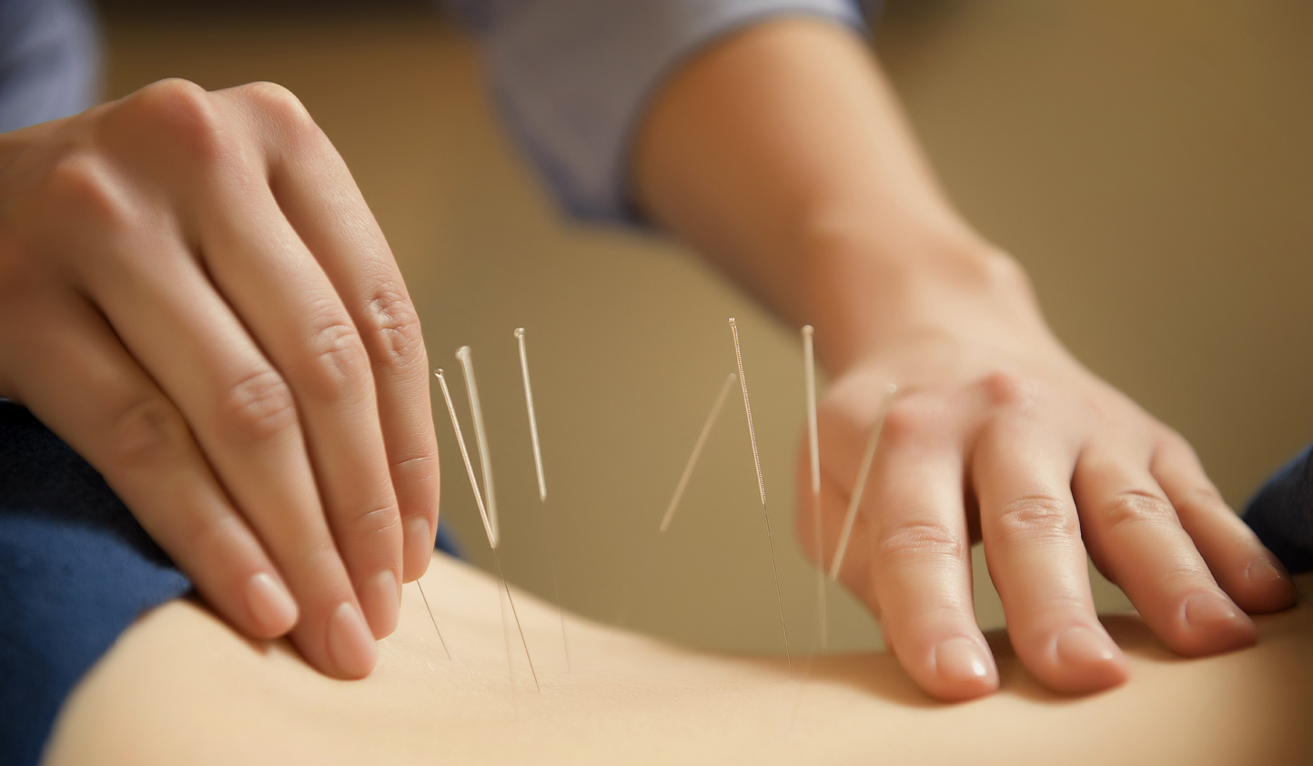 How much do you know about acupuncture