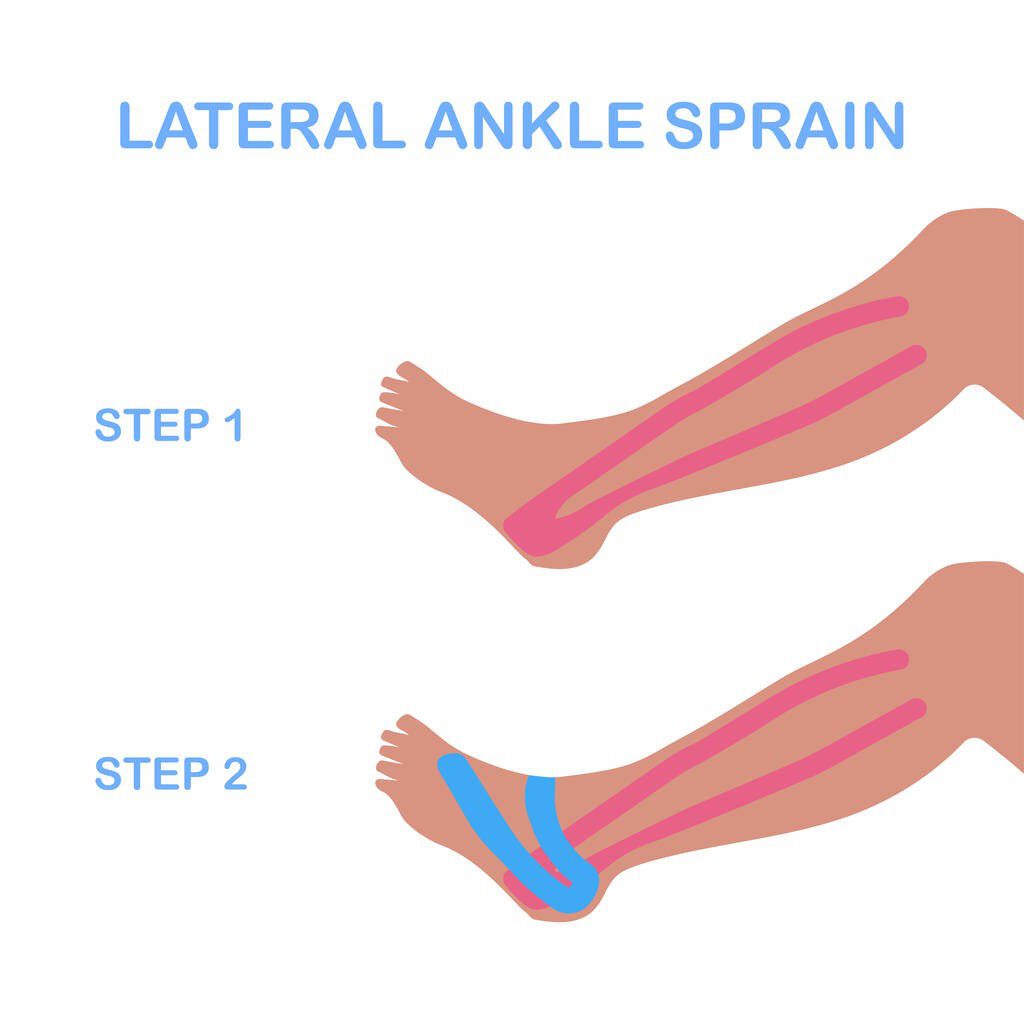 lateral ankle sprain