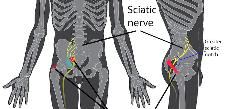 Do you know the causes of sciatica