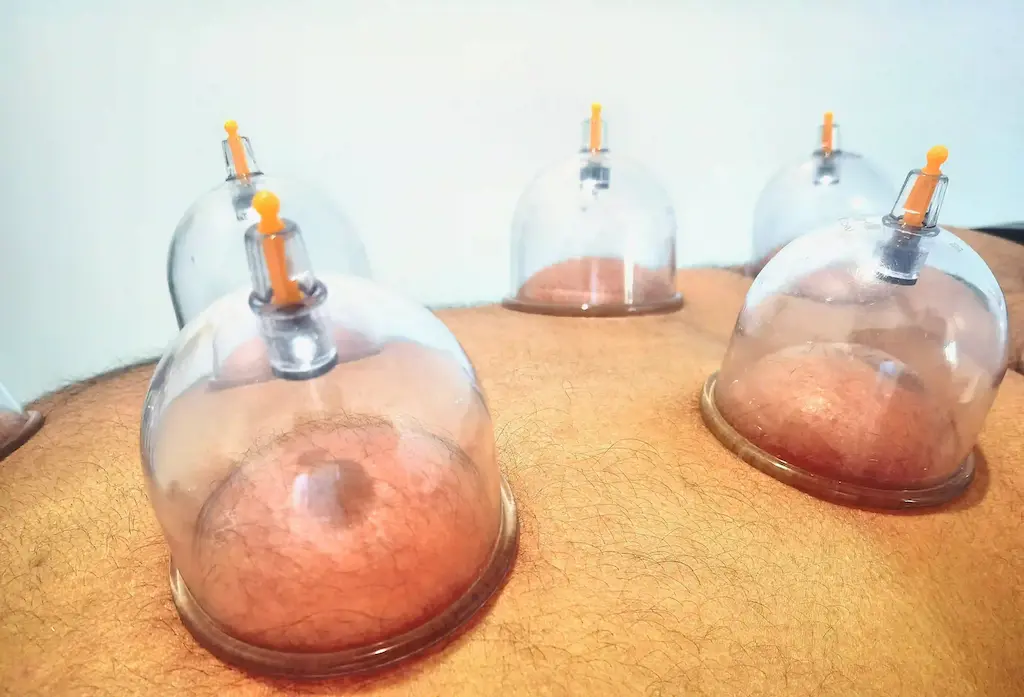cupping therapy near me