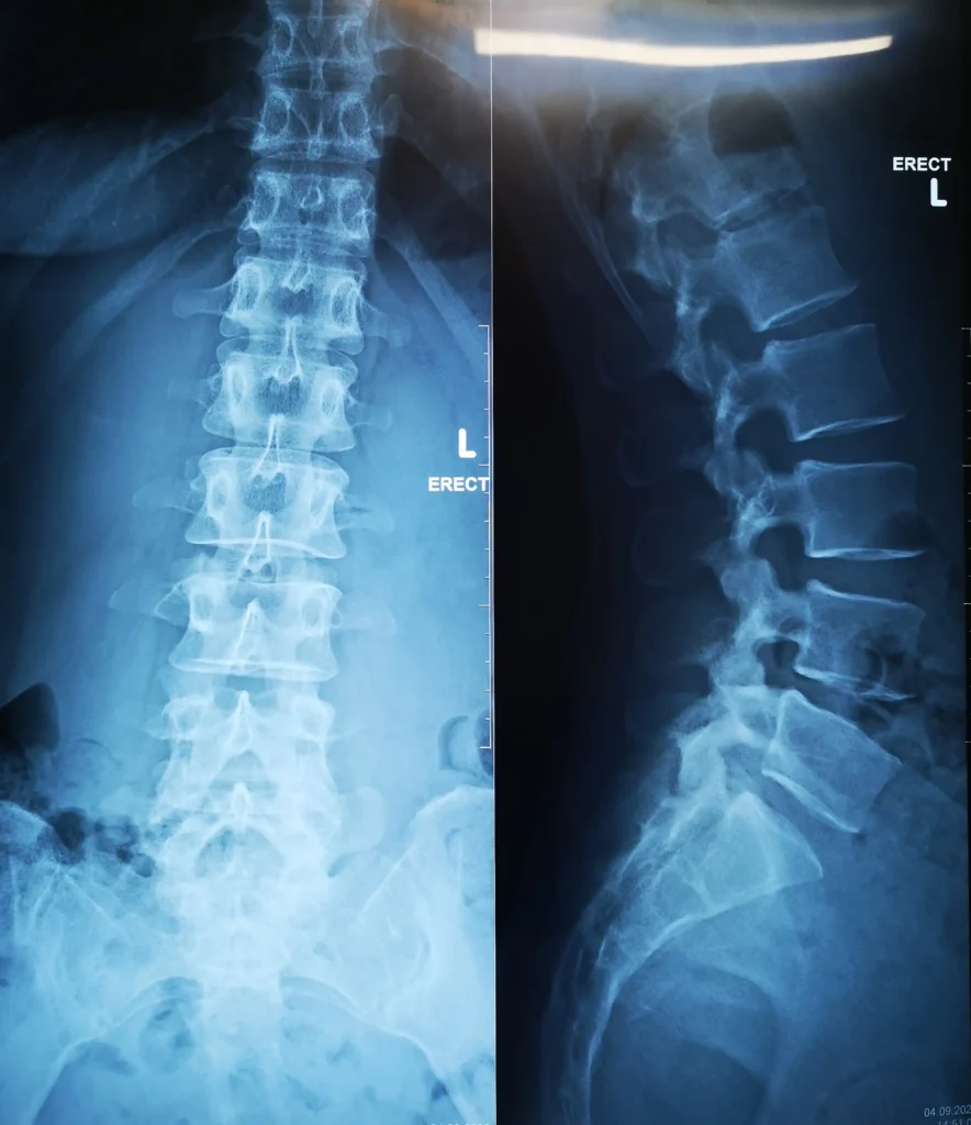 Can I See a Chiropractor for Scoliosis Treatment?