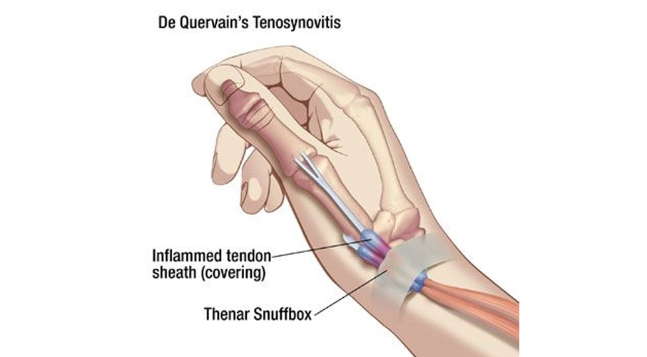 De Quervain’s Tenosynovitis: Symptoms and Treatment